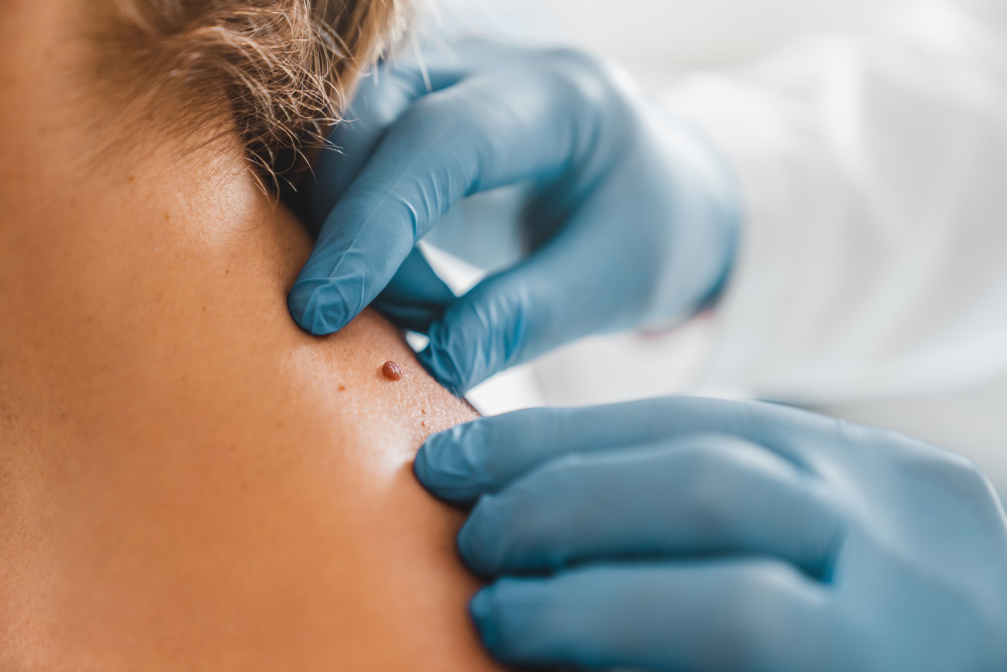 close-up-of-dermatologist-examining-patient-birthm-2025-01-09-05-49-41-utc