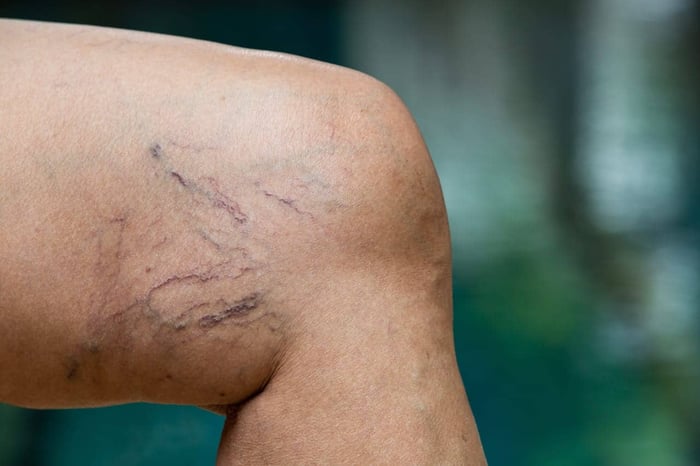 leg-veins-on-thigh