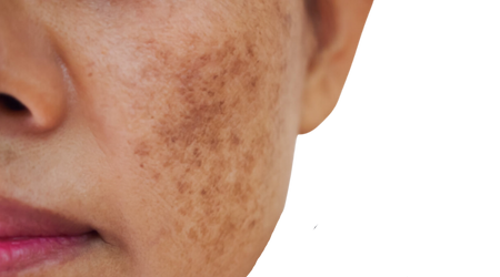 Acne (2)